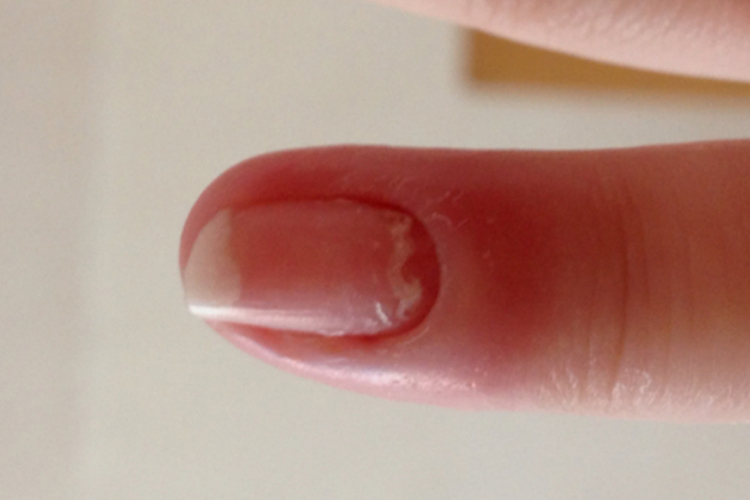 甲分离症状图 甲分离症状图