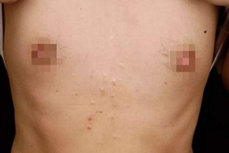 多发性皮脂腺囊肿前胸长小疙瘩图 多发性皮脂腺囊肿前胸长小疙瘩图