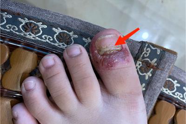 近端甲下型甲真菌病脚趾甲白斑图