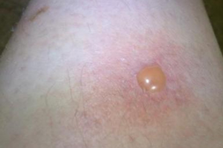 水痘小腿上有一个大水疱图