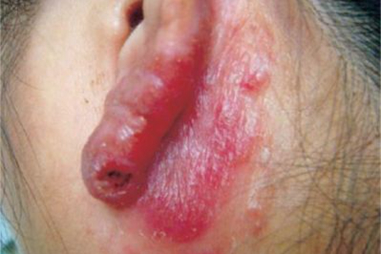 原发性皮肤结核综合征耳部症状图 原发性皮肤结核综合征耳部症状图