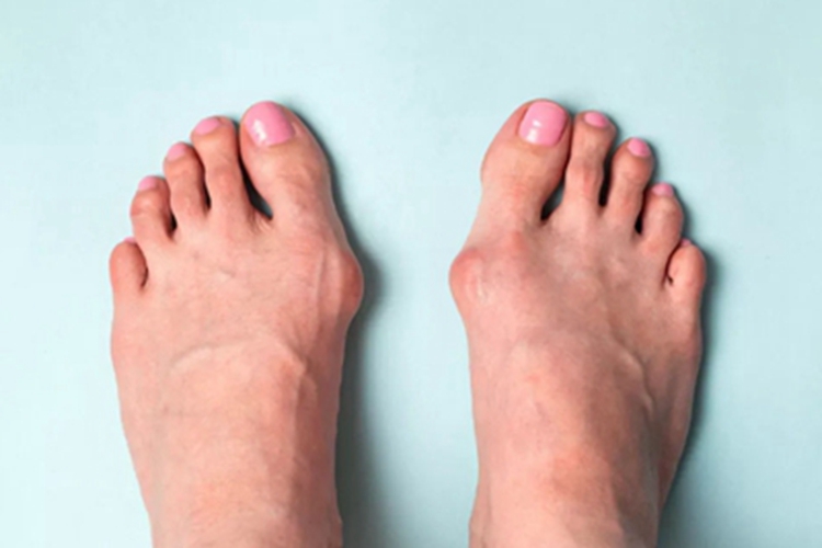 拇外翻大脚趾根部变形发红图 拇外翻大脚趾根部变形发红图