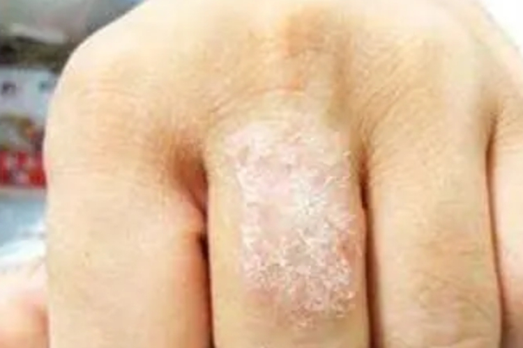 湿疹愈合脱屑图