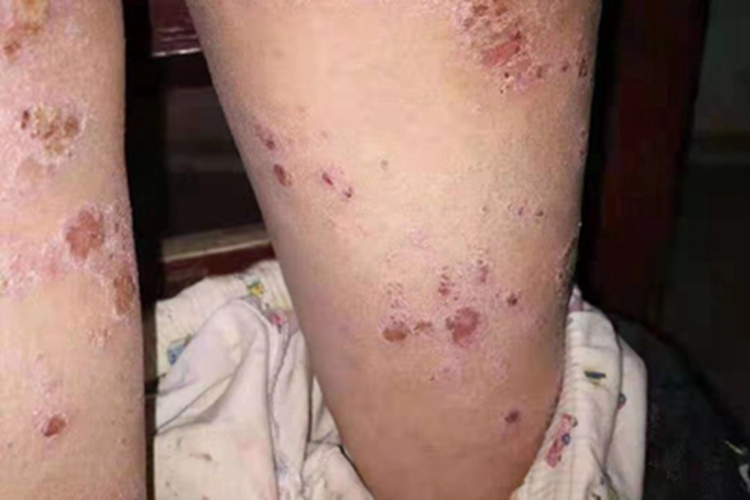 亚急性湿疹腿结痂图