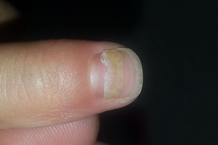甲癣指甲盖分层脱落图 甲癣指甲盖分层脱落图