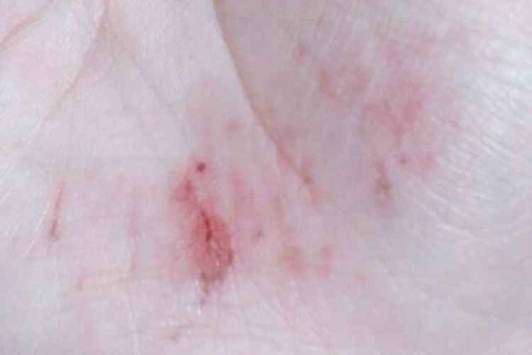 擦伤手掌症状图 擦伤手掌症状图