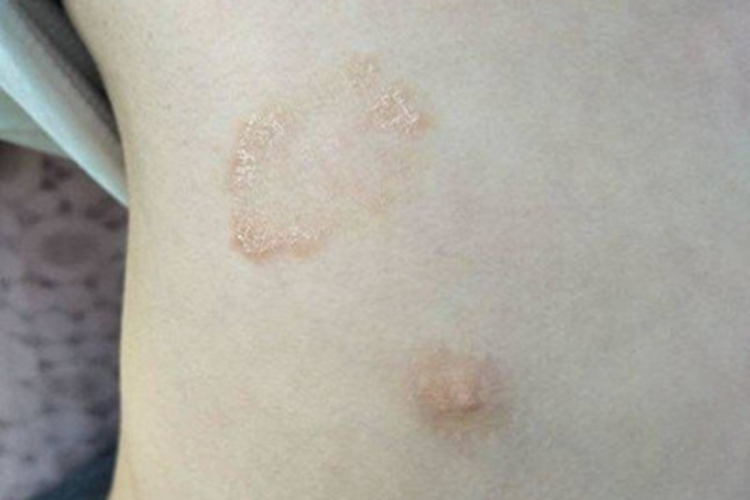 玫瑰糠疹胸部出现红斑图