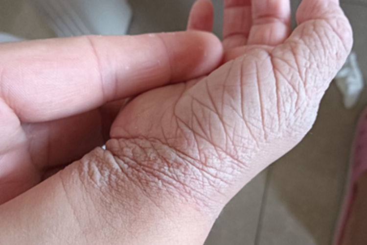 窝状角质松解症松弛图 窝状角质松解症松弛图