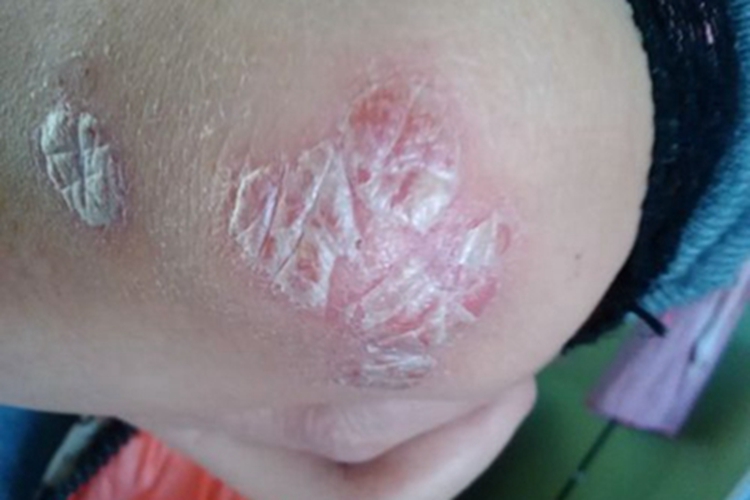 关节病型银屑病肘部症状图