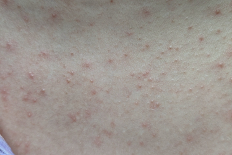 马拉色菌毛囊炎起粉刺图