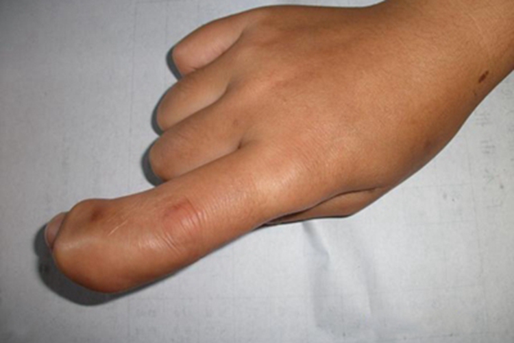 巨指畸形食指巨大图