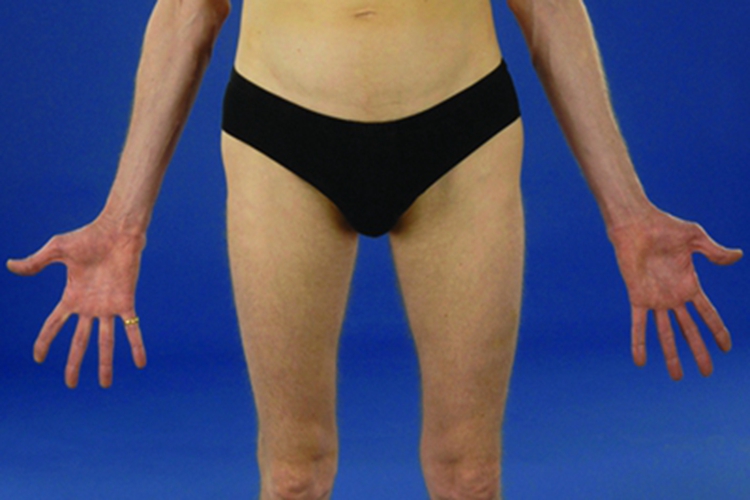 马方综合征胳膊细长图