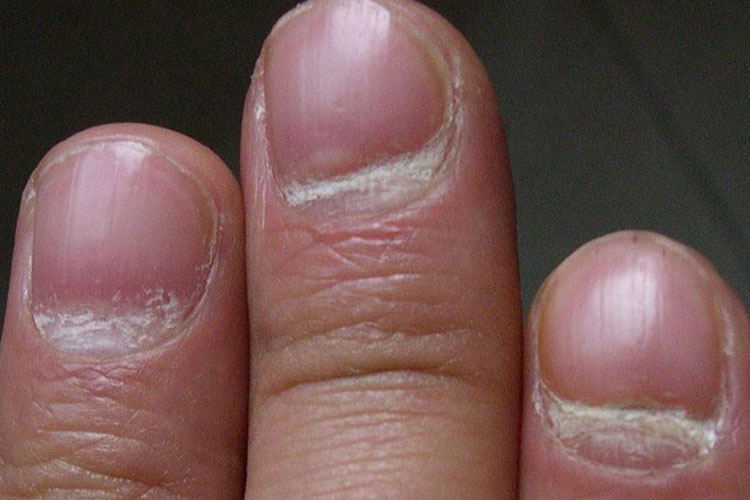 早期的灰指甲症状图片_有来医生