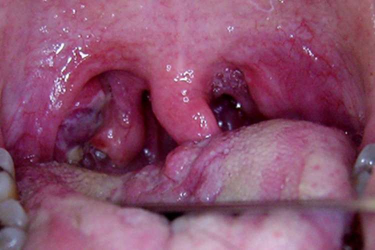 急性喉炎咽喉处红肿图