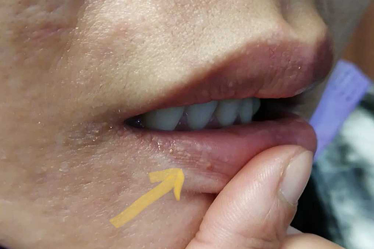 口唇上散在的白色丘疹图