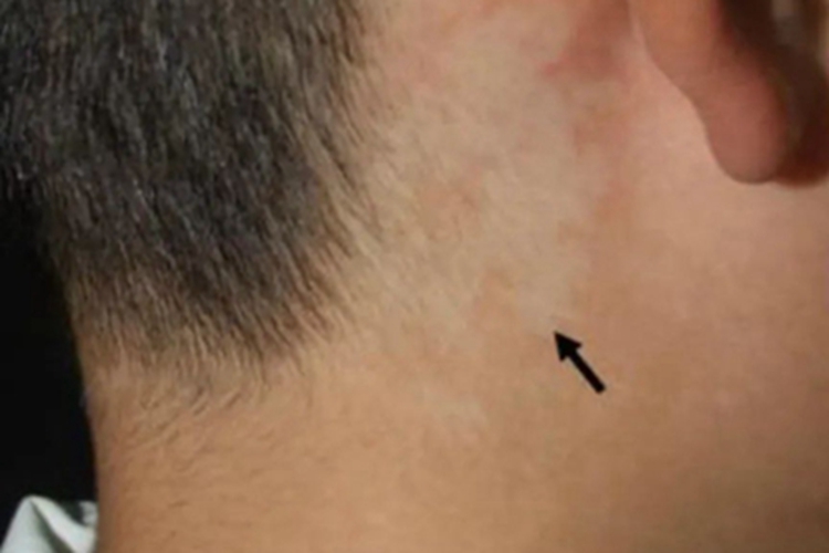 贫血痣耳后症状图