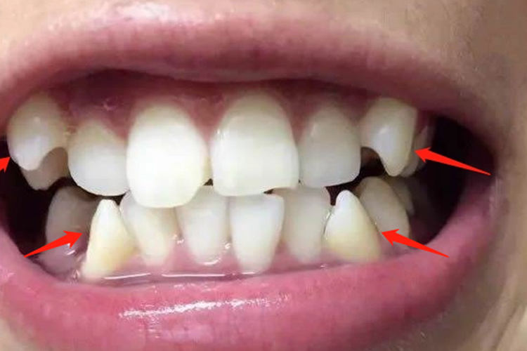 上颌尖牙与下颌尖牙图 上颌尖牙与下颌尖牙图