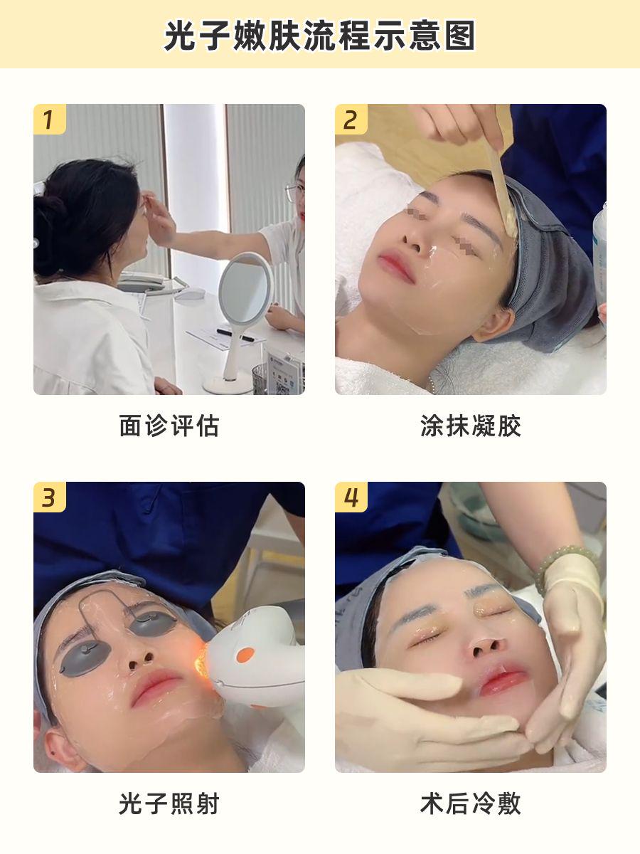 杭州光子嫩肤攻略：从原理到避坑指南