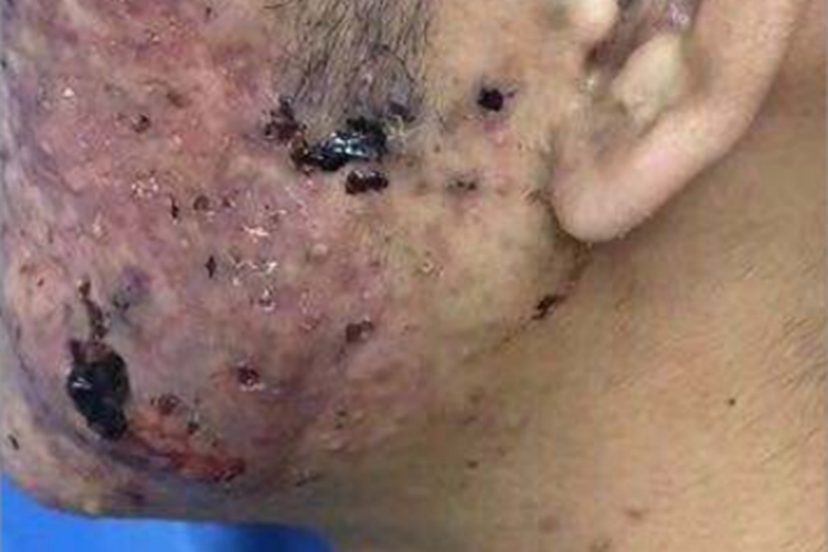 寻常痤疮黑色结痂图