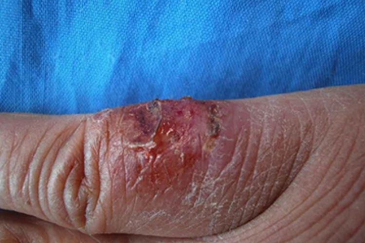 鼻孢子菌病手指糜烂图