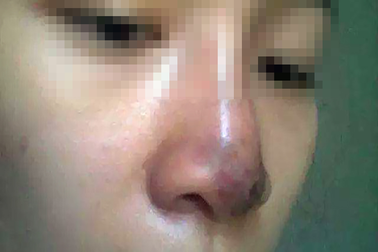 术后2天红肿停止进展图 术后2天红肿停止进展图