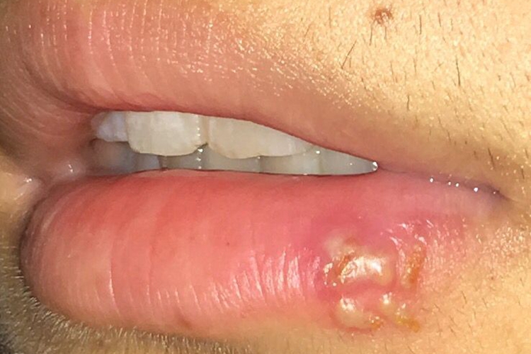 艾滋病唇缘单纯疱疹图 艾滋病唇缘单纯疱疹图