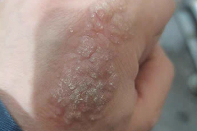 汗疱疹手背脱皮图