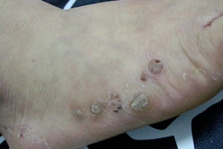 寻常疣脚部皮肤增厚图