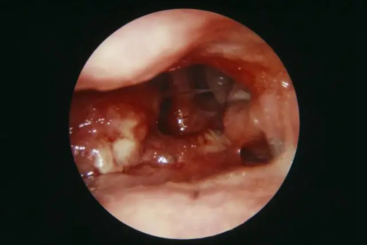 鼻窦癌鼻腔新生物图