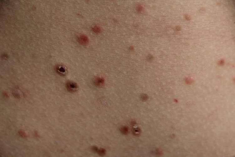 痘疮样副银屑病图 痘疮样副银屑病图