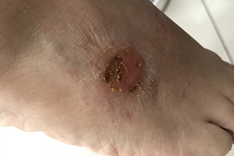 钱币状湿疹脚部结痂图