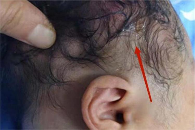 皮下血肿红肿图