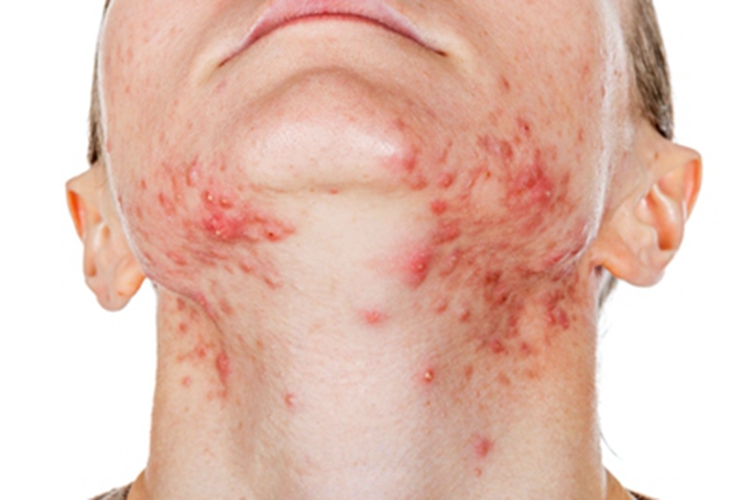 战壕热症状图 战壕热症状图