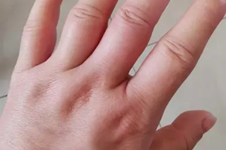 特发性水肿手指症状图