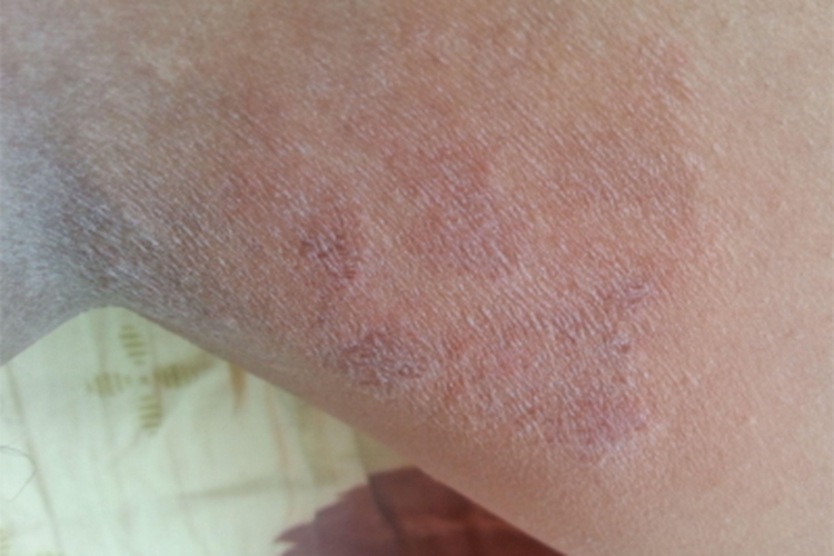 血管萎缩性皮肤异色病大腿红斑图 血管萎缩性皮肤异色病大腿红斑图