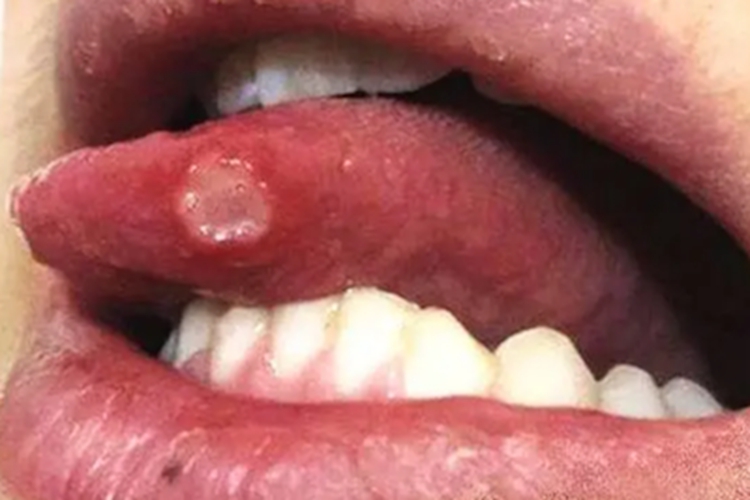 重型复发性阿弗他口腔炎症状图 重型复发性阿弗他口腔炎症状图