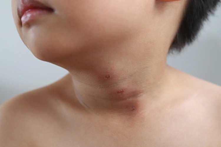 恙螨皮炎结痂图