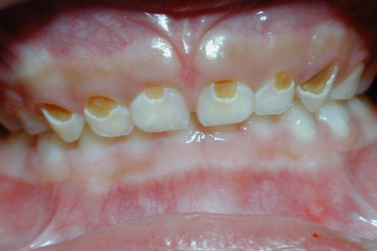 宝宝牙釉质脱落严重图