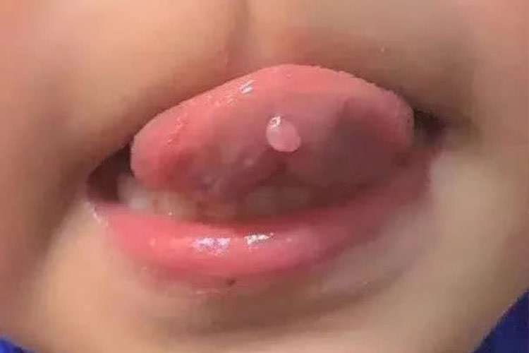 舌尖腹侧黏液腺囊肿图 舌尖腹侧黏液腺囊肿图