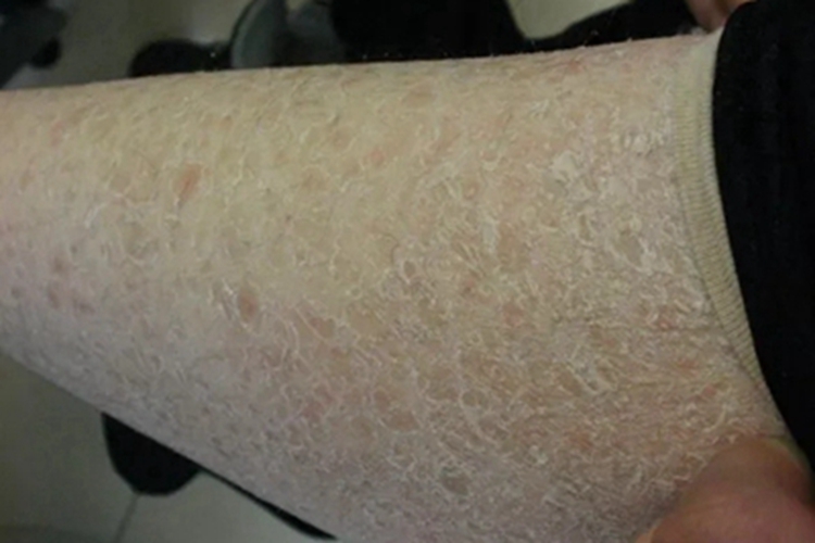 光老化皮肤脱屑图