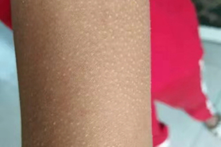 小棘苔藓胳膊小白丘疹图 小棘苔藓胳膊小白丘疹图