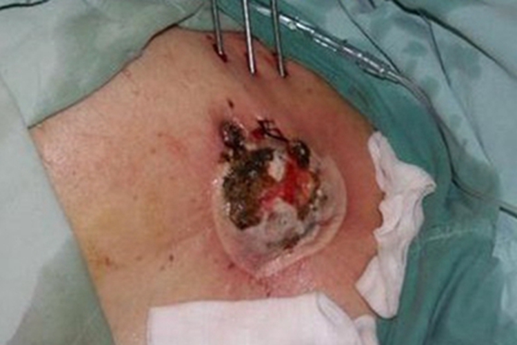 男性乳腺癌乳房结痂图 男性乳腺癌乳房结痂图