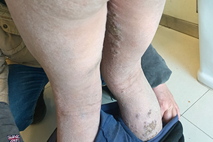 皮肤垢着病腿皮肤发黑图