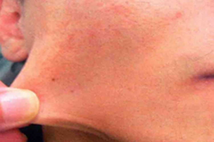 皮肤弹性过度面部松弛图