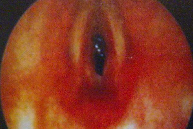 喉炎黏膜水肿图