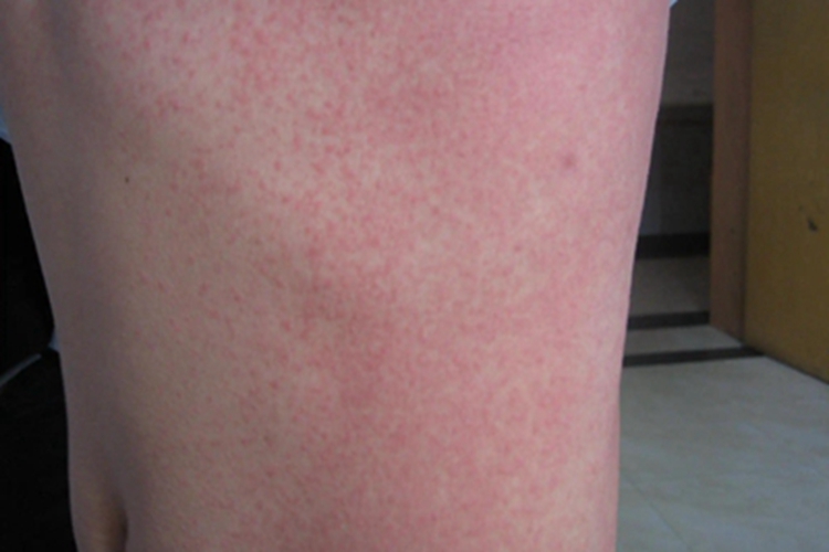猩红热型药疹肋部症状图
