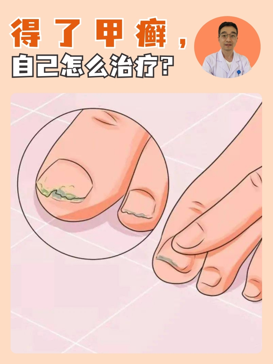 得了甲癣，自己怎么治疗？