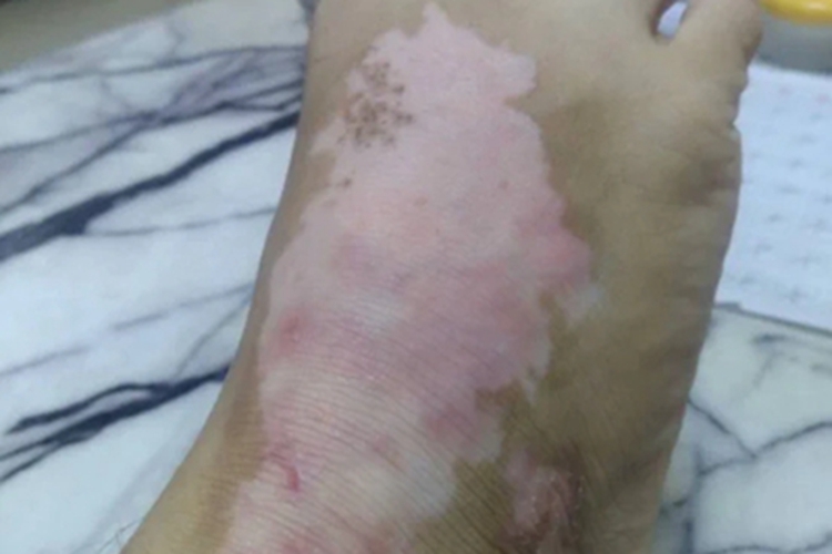 节段型白癜风脚背白斑图
