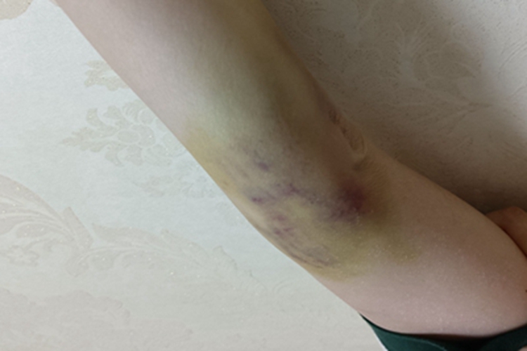 挫伤胳膊症状图