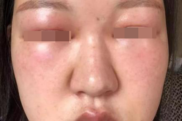 脸部轻度水肿图